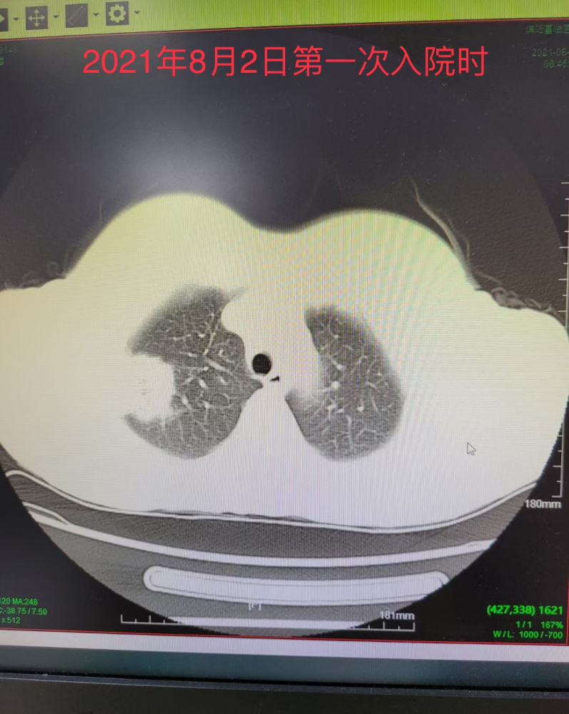 病例绵阳富临医院呼吸与危重症医学科成功救治一例鹦鹉热衣原体肺炎